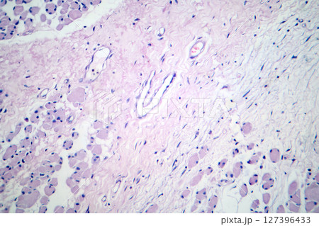 Skeletal muscle atrophy, photomicrograph showing decreased fiber size with increased spacing between them, reduced myofibrils, increased endomysial connective tissue with fatty infiltration 127396433