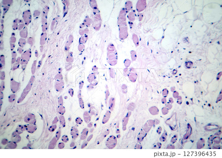 Skeletal muscle atrophy, photomicrograph showing decreased fiber size with increased spacing between them, reduced myofibrils, increased endomysial connective tissue 127396435