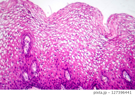 Atypical squamous epithelial hyperplasia, photomicrograph showing thickened stratified epithelium with nuclear atypia and basal layer crowding Atypical squamous epithelial hyperplasia, photomicrograph showing thickened stratified epithelium with nuclear atypia and basal layer crowding 127396441