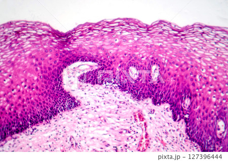 Atypical squamous epithelial hyperplasia, photomicrograph showing thickened stratified epithelium with nuclear atypia and basal layer crowding Atypical squamous epithelial hyperplasia, photomicrograph showing thickened stratified epithelium with nuclear atypia and basal layer crowding 127396444
