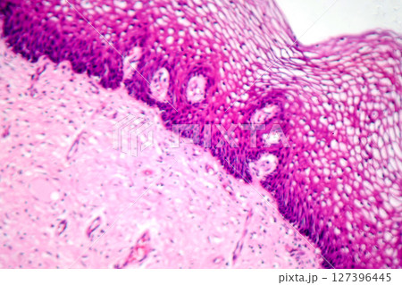 Atypical squamous epithelial hyperplasia, photomicrograph showing thickened stratified epithelium with nuclear atypia and basal layer crowding Atypical squamous epithelial hyperplasia, photomicrograph showing thickened stratified epithelium with nuclear atypia and basal layer crowding 127396445