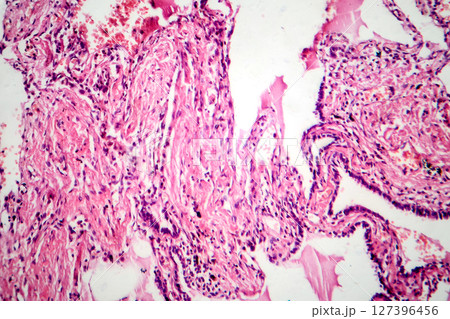 Red hepatization stage of lobar pneumonia, photomicrograph showing alveolar exudate with red cells, neutrophils, and fibrin strands 127396456