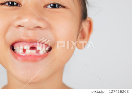 A smiling girl shows her missing tooth. The dentist discusses tooth loss and dental care, highlighting the natural process of losing baby teeth and growing new ones. close up 127416268