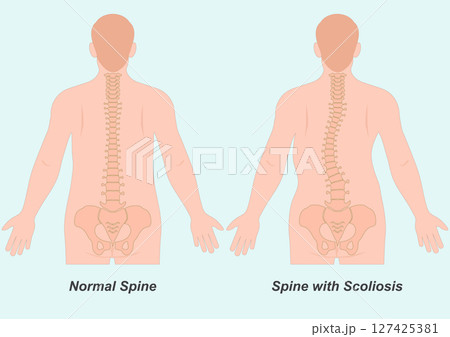 Scoliosis is a side to side curve of spine. Scoliosis is a side to side curve of spine. 127425381