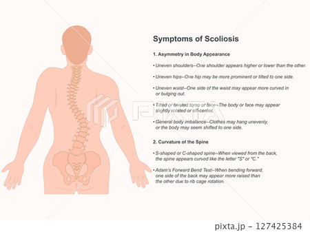 Symptoms of Scoliosis is a sideways curving and twisting of the spine. 127425384