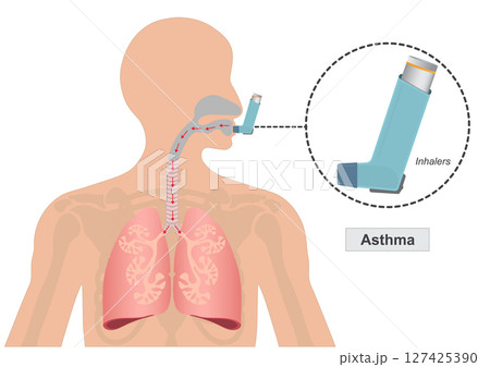 Asthma is a chronic lung disease affecting. Asthma is a chronic lung disease affecting. 127425390