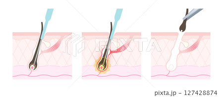 ニードル脱毛 施術の流れ 127428874