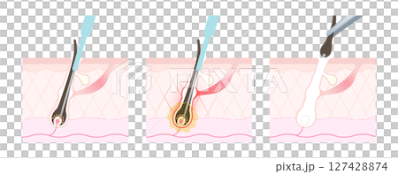 ニードル脱毛 施術の流れ 127428874