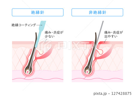 ニードル脱毛 絶縁針と非絶縁針の違い 127428875