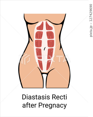 Diastasis Recti after Pregnancy in a woman. The anatomy of a Woman. Woman muscular corset after childbirth. Vector illustration 127429690