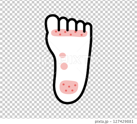 腳癬圖示插圖向量 腳癬圖示插圖向量 127429881