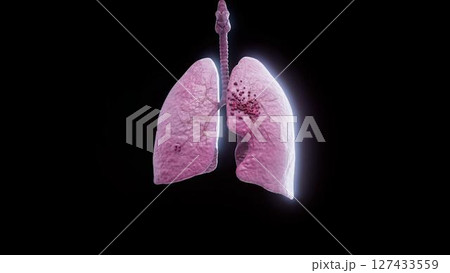 lungs_real_cancer 127433559