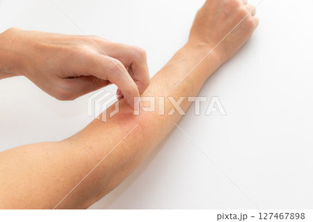 虫に刺された腕を指で掻く 127467898