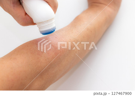 虫に刺された腕に薬を塗る 127467900