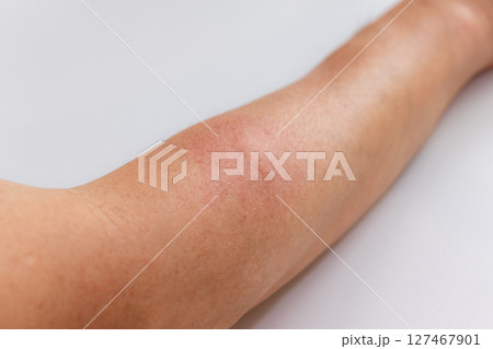 虫に刺されて赤く腫れた腕 127467901