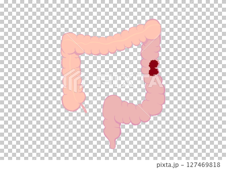 Colon cancer colon Colon cancer colon 127469818