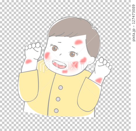 Baby eczema 127473089