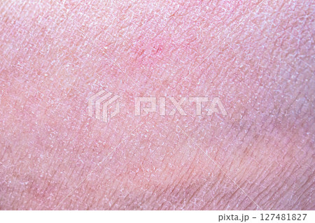 dry and dehydrated human skin texture background 127481827