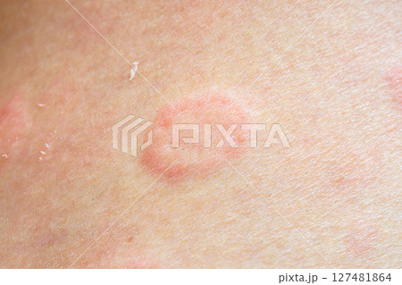 Skin allergy rash dermatitis texture close up background Skin allergy rash dermatitis texture close up background 127481864