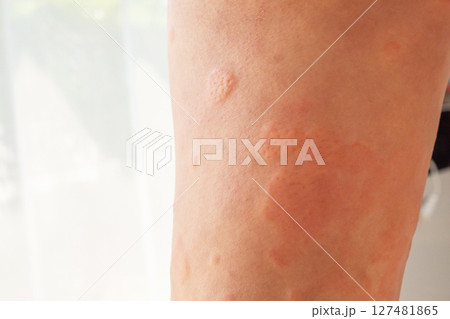 Young asian man has allergic skin rash on his legs from itchy dry skin eczema dermatitis insect bites 127481865