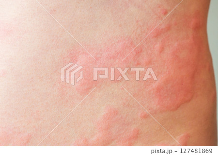 Skin allergy rash dermatitis texture close up background 127481869