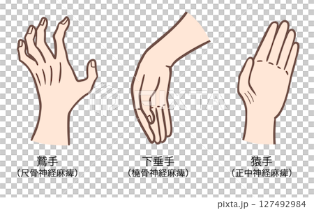 Claw hand, drop hand, monkey hand, hand deformity due to nerve paralysis of the upper limbs 127492984