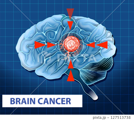 Illustration of Brain Cancer Cell in Human Brain 127513738