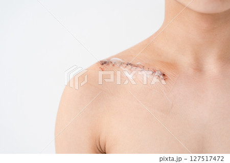 傷口　怪我　縫い合わせ　傷痕 127517472