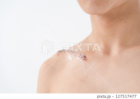 傷口　怪我　縫い合わせ　傷痕 127517477