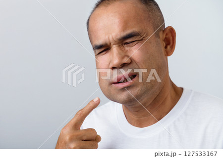 Man has facial swelling due to an allergic reaction to triggers such as insect bites, food Man has facial swelling due to an allergic reaction to triggers such as insect bites, food 127533167