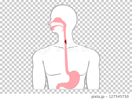 Esophageal cancer inside the human body Esophageal cancer inside the human body 127545730