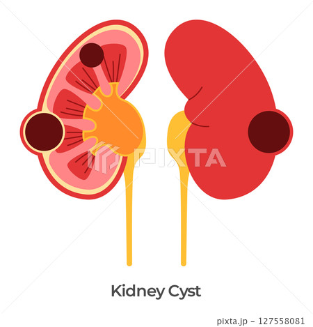 Kidney cyst renal cysts illustration anatomy drawing of fluid filled sacs in kidneys 127558081
