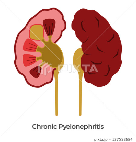 Kidney Pyelonephritis kidneys bacterial infection anatomy drawing illustration Kidney Pyelonephritis kidneys bacterial infection anatomy drawing illustration 127558684