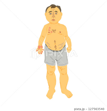 肝硬変に伴う身体症状の視覚的解説イラスト 127563540