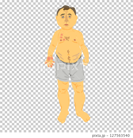 肝硬変に伴う身体症状の視覚的解説イラスト 127563540