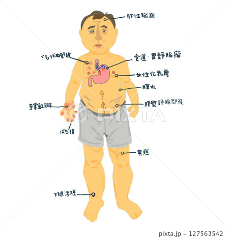 肝硬変に伴う身体症状の視覚的解説イラスト 127563542