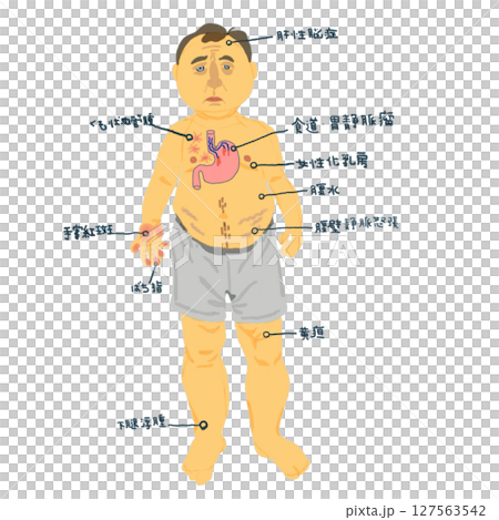 肝硬変に伴う身体症状の視覚的解説イラスト 127563542