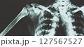 X-ray texture exhibiting a unique grainy and speckled look with a ghostly effect. 127567527