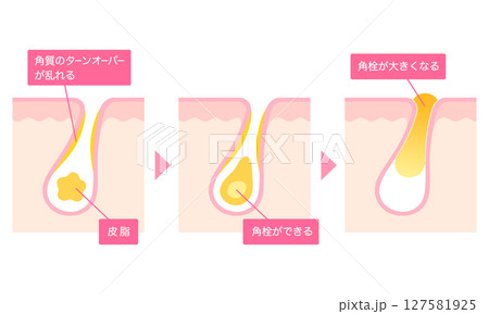 角栓の詰まった毛穴　断面図 127581925