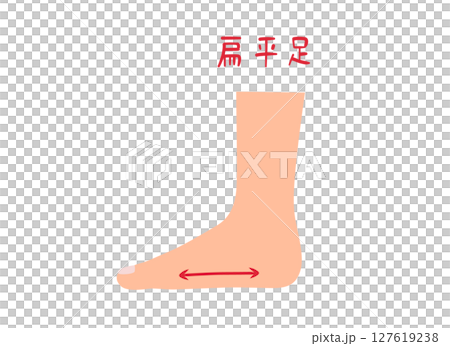 足裏のアーチがない偏平足のイラスト素材 127619238