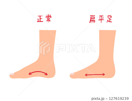 偏平足と正常な足のセットイラスト 偏平足と正常な足のセットイラスト 127619239