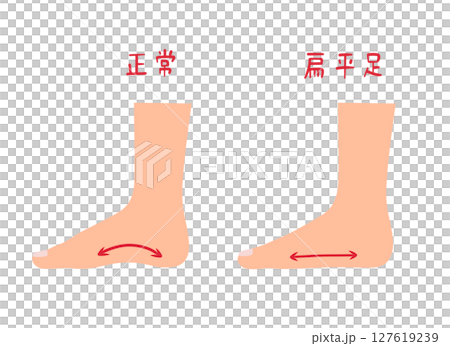 偏平足と正常な足のセットイラスト 偏平足と正常な足のセットイラスト 127619239