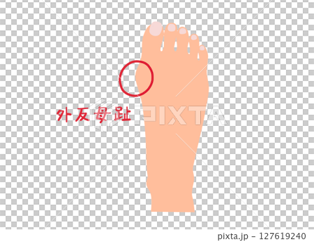 無主線拇趾外翻圖解 127619240