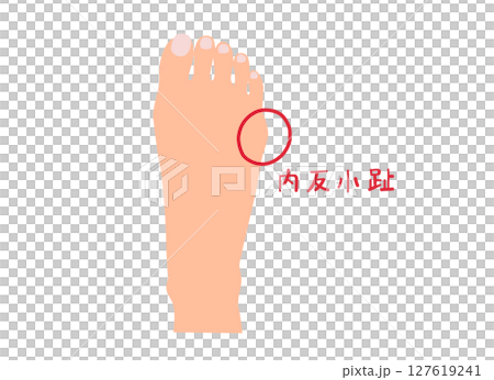 無主線拇趾外翻圖解 127619241