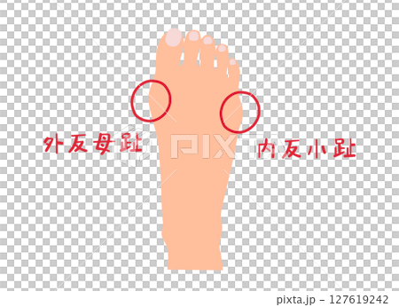 拇趾外翻和小趾內翻無主線的簡單圖示 127619242