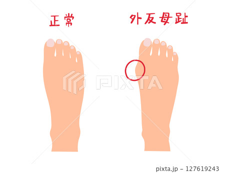 外反母趾と正常な足の主線なしシンプルイラストセット 127619243