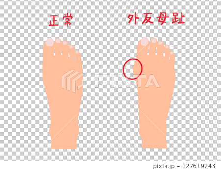 外反母趾と正常な足の主線なしシンプルイラストセット 127619243