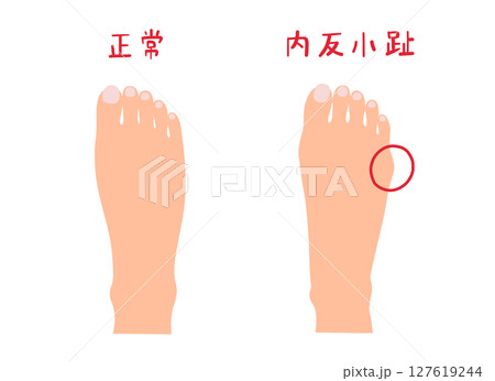 内反小趾と正常な足の主線なしシンプルイラストセット 127619244