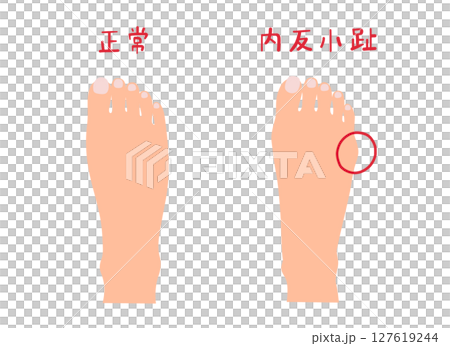 内反小趾と正常な足の主線なしシンプルイラストセット 127619244