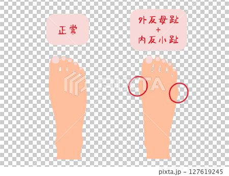拇外翻、拇囊炎和正常足部無主線的簡單圖示 127619245